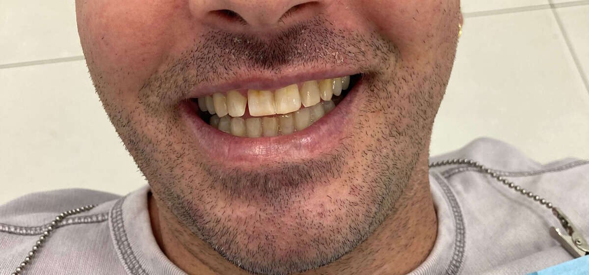 carillas-dentales-antes-01