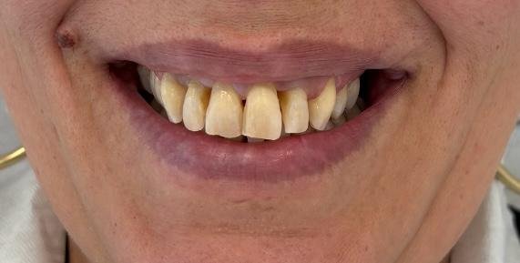 carillas-dentales-antes