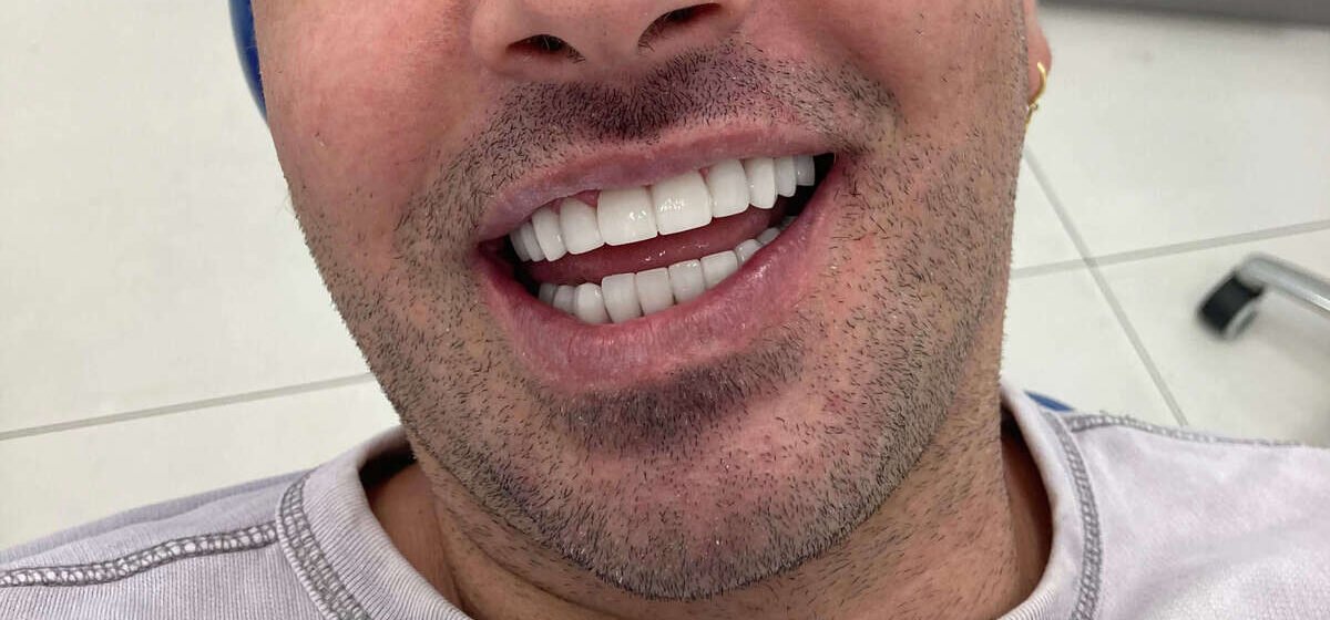 carillas-dentales-despues-01