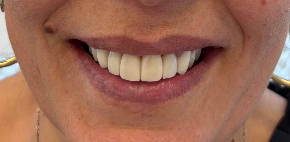 carillas-dentales-despues-4